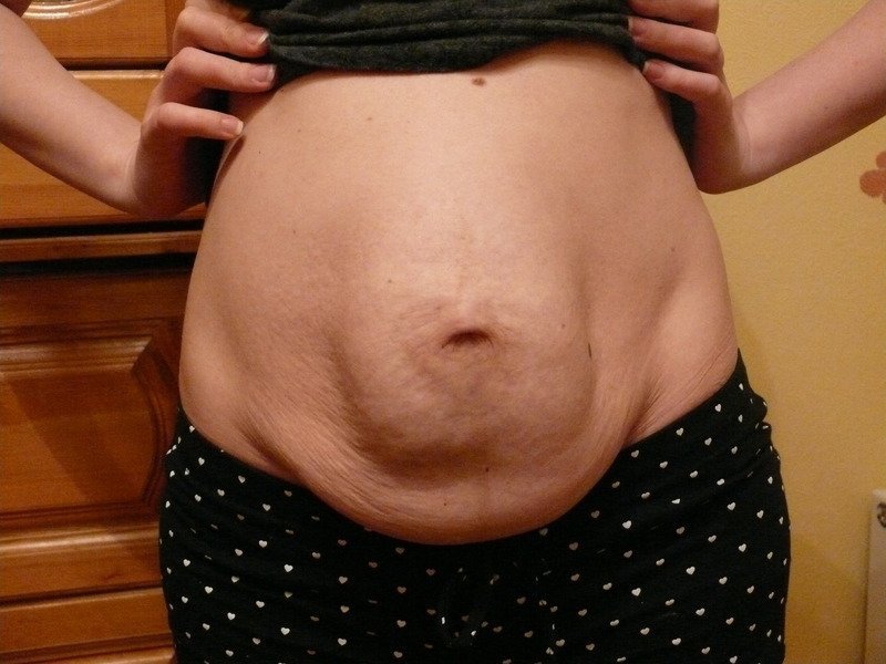 Abdominoplastika uchun ko'rsatmalar