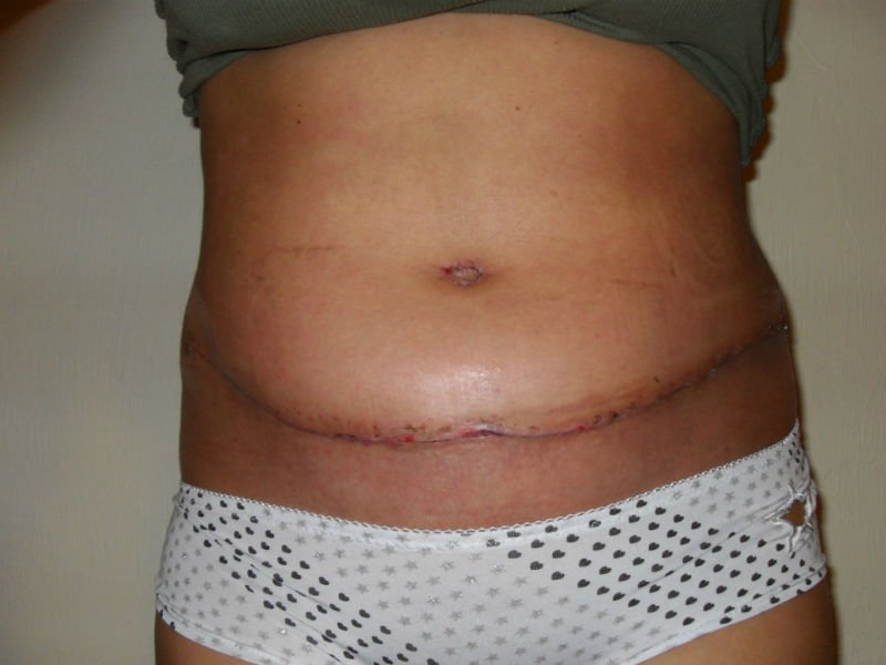 Abdominoplastikadan keyin shishgan qoringa o'xshaydi