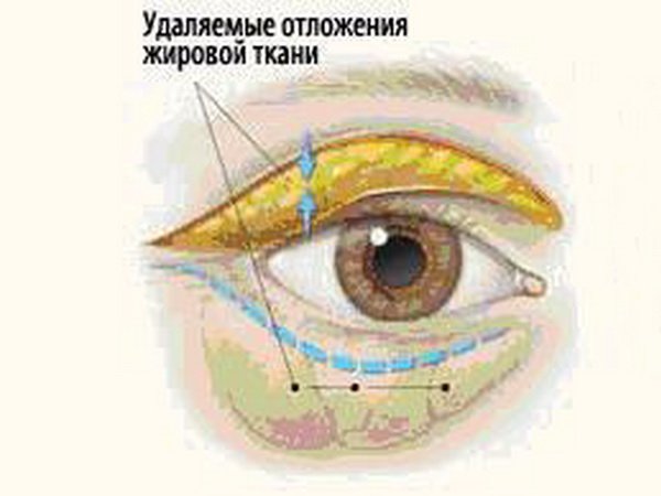 Blefaroplastikada olinadigan yog'li to'qimalar