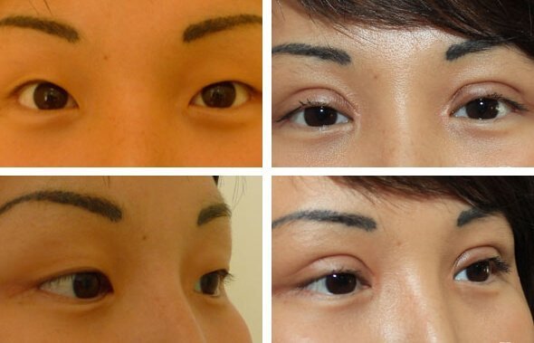 Oriental Blefaroplastika