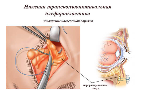 Transkonjonktival pastki ko'z qovoqli blefaroplastika