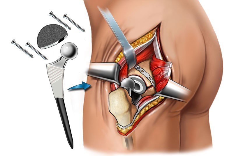 Kestirib, artroplastika