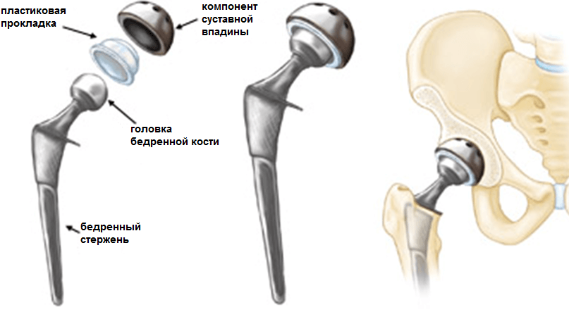 Kestirib, artroplastika