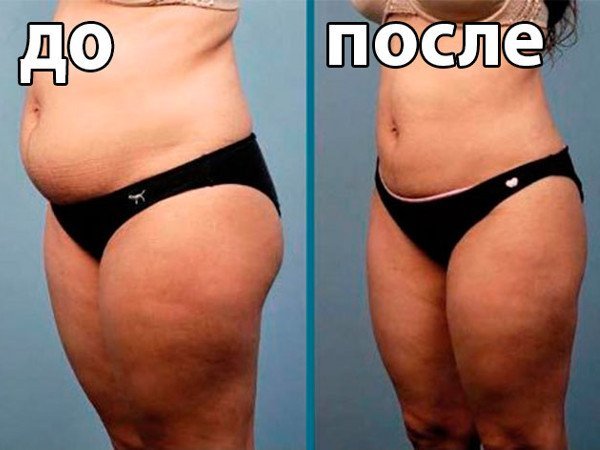 Liposuction operatsiyasi: natijalar