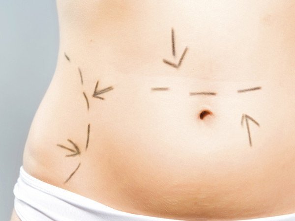 Mahalliy liposuction