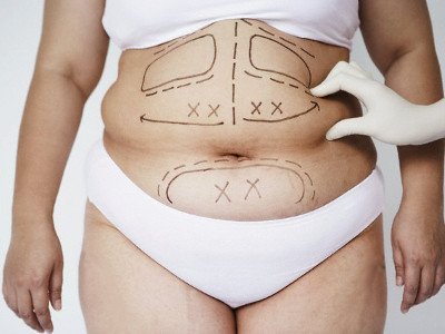 Obezlik uchun liposuction