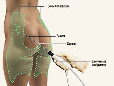 Vakuum liposuction qanday qilinadi