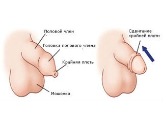 Plastik fimozli suyuqlik