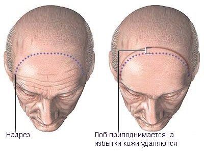 Peshonani koronar qaltirash