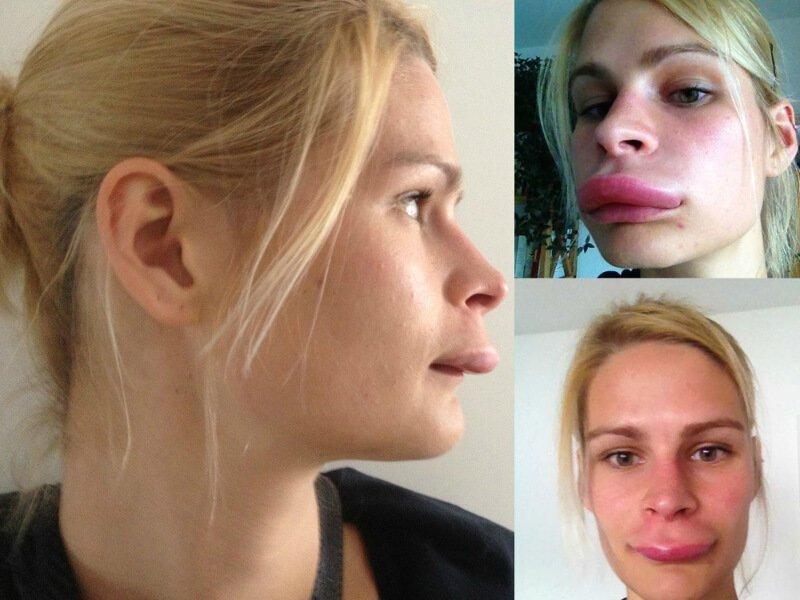 Botox bilan lip artishining oqibatlari