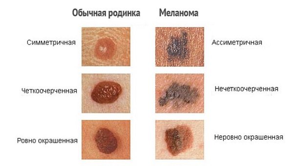 Melanoma va odatdagi mol o'rtasidagi farq