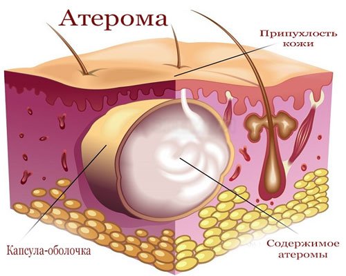 Ateroma