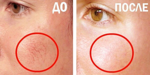 Rosacea davolashdan oldin va keyin