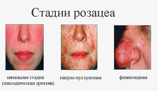 Rosacea bosqichlari