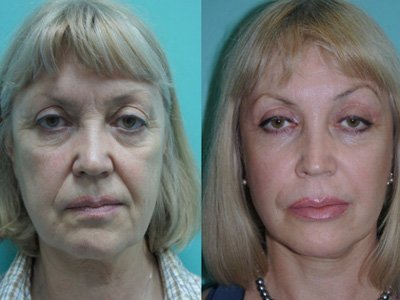 AOK mumkin facelift natijasi