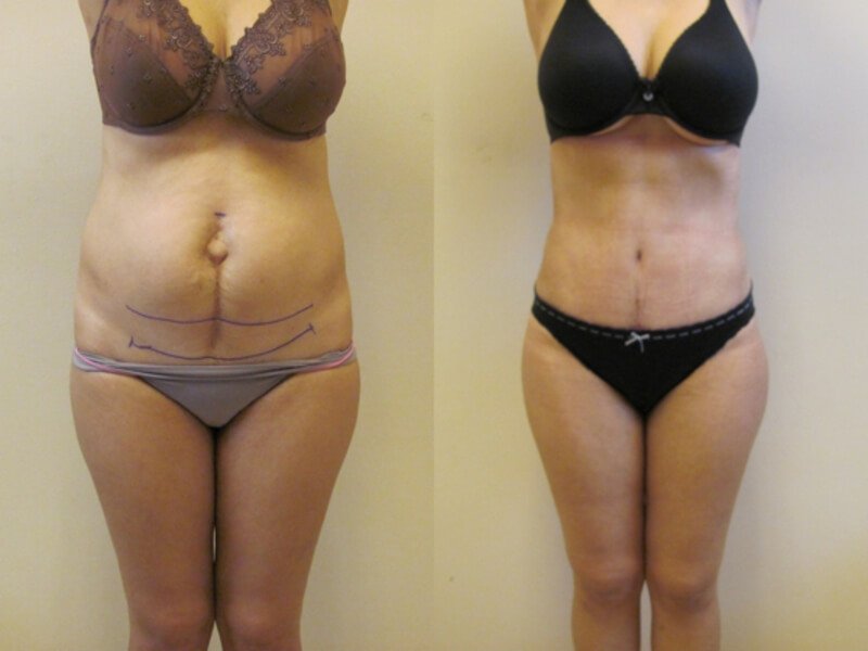 Abdominoplastika: oldin va keyin