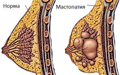 Mastopatiya ko'krak ko'tarmasidan keyin rivojlanishi mumkin.