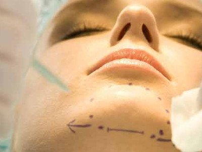 Ikkinchi chin liposuction natijalari