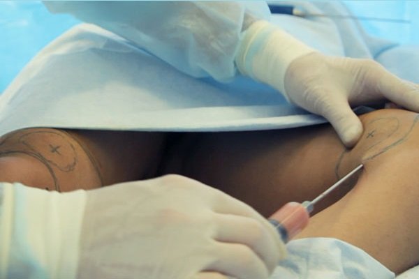 Tizlarning liposuction