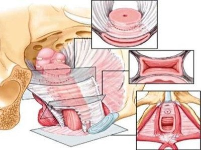 Vaginal qisqartirish operatsiyasi