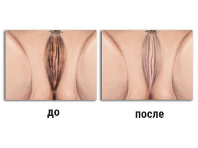 Lazer vaginal siqish usuli