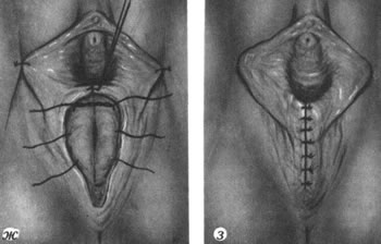 Tug'ilgandan keyin vagina plastini o'tkazish